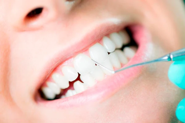 Limpieza dental