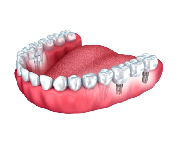 Prótesis dentales fijas